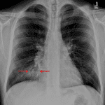 Pulmonary abscess: nodular opacity in the right middle lobe with an air-fluid level (red arrows).