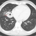 Pulmonary abscess: the fluid and gas collection forms an acute angle with the adjacent pleural surface, suggesting that the collection is in the lung instead of the pleural space.
