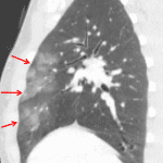 Pulmonary contusion: groundglass opacities in the anterior aspects of the right upper and middle lobes (red arrows).