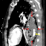 Blood filled pulmonary laceration (red arrows) in the left lower lobe with internal active hemorrhage (yellow arrow).