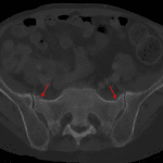 Bilateral sacral insufficiency fractures (red arrows).