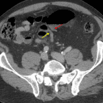 Close approximation of the ingoing (red arrow) and outgoing (yellow arrow) bowel loops adjacent to the narrow mesenteric pedicle associated with the involved loop of sigmoid colon.