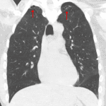 Biapical blebs (red arrows) in this young patient presenting with spontaneous pneumothorax.