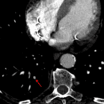 Subtle nonocclusive subsegmental pulmonary embolism in the right lower lobe (red arrow).