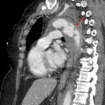 Severe acute traumatic aortic injury at the isthmus (red arrow) with extensive surrounding mediastinal hemorrhage.