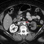 Additional aortic injury just distal to the diaphragmatic hiatus with at least partial occlusion of the left renal artery (red arrow) resulting in hypoperfusion of the left kidney (yellow arrow).