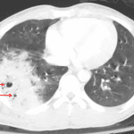 Red arrows: examples of traumatic pneumatoceles within a large pulmonary laceration in the right lower lobe.