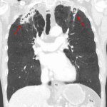 Bilateral upper lobe cavitary lesions in this patient with concern for postprimary/reactivation pulmonary tuberculosis.