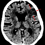Area of loss of gray-white differentiation in the left frontal lobe (red arrows) concerning for acute or subacute ischemia.