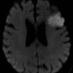 Area of ischemia confirmed on the subsequent MRI, as shown on this DWI sequence.