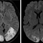 The patient's subsequent MRI demonstrates extensive edema in the bilateral parieto-occipital regions (as shown on the T2-FLAIR sequence on the left) and predominantly cortical ischemia in the same region (as shown on the diffusion sequence on the right).