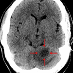 Hypodense lesion in the superior left cerebellar hemisphere (red arrows).