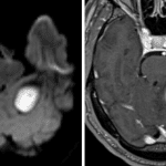 Subsequent brain MRI findings are highly concerning for abscess including central restricted diffusion (image on left) and peripheral enhancement (image on right).