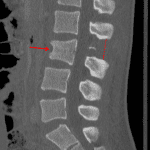 Chance fracture with a horizontally-oriented L3 fracture involving all three columns (red arrow) and distraction of the posterior elements with widening of the L2-L3 interspinous distance (red dotted line).