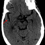 Focal hyperdensity in an M2 branch of the right MCA concerning for thrombus (red arrow).