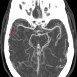 Red arrow: right M2 cutoff confirmed on this maximum intensity projection from the subsequent CTA.
