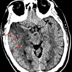 Area of hypoattenuation in the right temporal lobe (red arrows).