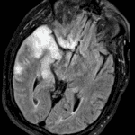 Abnormal signal and gyral expansion in the right temporal lobe with notable involvement of mesial structures on the T2-FLAIR sequence from this patient's subsequent MRI.