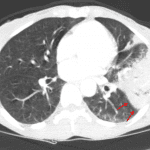 Klebsiella pneumonia with the characteristic bulging fissure sign (red arrows).