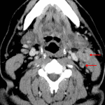 Enlarged, centrally necrotic left level II cervical lymph nodes (red arrows).