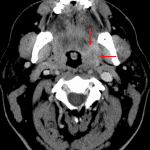 Subtle soft tissue mass centered in the left palatine tonsil extending into the glossotonsillar sulcus (red arrows).