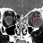 Subperiosteal abscess in the superomedial left orbit (red arrows).