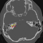 Otic capsule involving right temporal bone fracture with a visible fracture line (red arrow) and gas in the vestibular apparatus (yellow arrow).