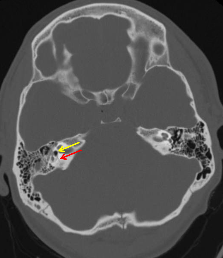 CaseStacks.com - Neuroradiology CT Case #16