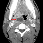 Right peritonsillar abscess (red arrow) with associated mass effect on the right eccentric oropharynx.