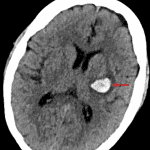 Acute left putaminal intraparenchymal hematoma (red arrow).