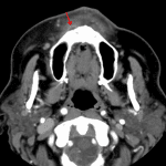 Small right maxillary subperiosteal abscess (red arrow).