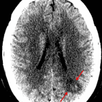 Area of hypodensity in the left MCA/PCA watershed zone concerning for acute ischemia (red arrows).