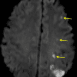 Diffusion sequence from the subsequent MRI showing acute infarcts along the left MCA/PCA (red arrow) and ACA/MCA (yellow arrows) watershed zones.