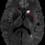 Diffusion sequence from the subsequent MRI confirming an acute left caudate head infarct (red arrow).