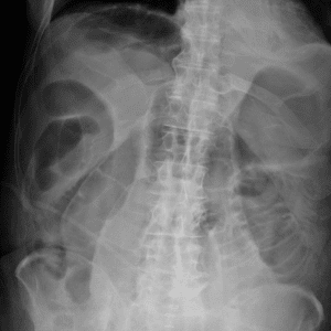 Pneumoperitoneum