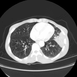 Lobar pneumonia (Klebsiella)