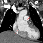 Red arrows: annuloaortic ectasia in this patient with Marfan syndrome.