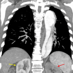 Aortic dissection resulting in compromised flow through the left renal artery and hypoperfusion of the left kidney (red arrow) relative to the right (yellow arrow).