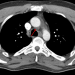 Red arrow: conspicuous fluid in the aortic recess of the transverse pericardial sinus, which can be mistaken for periaortic hematoma.