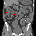 Ileocolic intussusception with bowel and mesenteric fat/vessels telescoping into the intussuscipiens (the receiving distal bowel segment).