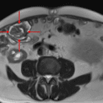 Intraluminal cecal mass shown on the subsequent MRI (red arrows) concerning for neoplastic lead point.