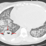 Red arrows: right lower lobe pulmonary abscess. Notice how this forms acute (less than 90 degree) angles with the adjacent pleura, which favors intrapulmonary location.