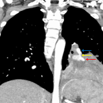 Necrotizing pneumonia complicated by a pulmonary artery pseudoaneurysm (red arrow) which shows a direct communication (yellow arrow) with a pulmonary arterial branch (blue arrow).