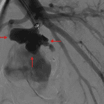 Pulmonary artery pseudoaneurysm confirmed on subsequent catheter angiogram (red arrows).