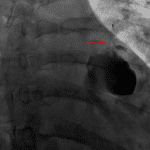 A plug (red arrow) was placed in the neck of the pseudoaneurysm.