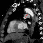 Red arrow: focal intimal tear at the attachment of the ligamentum arteriosum and small outpouching concerning for pseudoaneurysm.