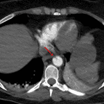 Red arrow: mild traumatic aortic injury near the diaphragmatic hiatus.