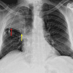 Right upper lobe collapse. The minor fissure is elevated laterally (red arrow) but not as elevated centrally (yellow arrow) raising concern for a perihilar mass.