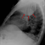 Right upper lobe collapse. Lateral view shows a paradoxical bulging appearance along the inferior margin of the collapsed lobe concerning for mass (red arrows).