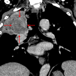 Subsequent CT confirmed the presence of a suprahilar mass with bronchial invasion (red arrows), though the mass is difficult to distinguish from the adjacent atelectatic lung.